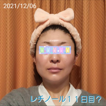 トレチノインジェル/A-Ret/美容液を使ったクチコミ(1枚目)