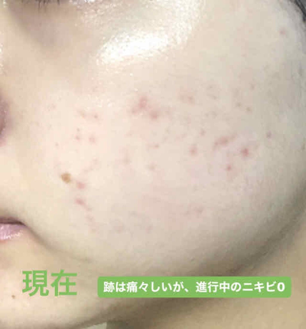**むぎちゃん** on LIPS 「なぜ私が肌荒れしたのかおはようございます☀︎私自身、自分の肌荒..」(4枚目)