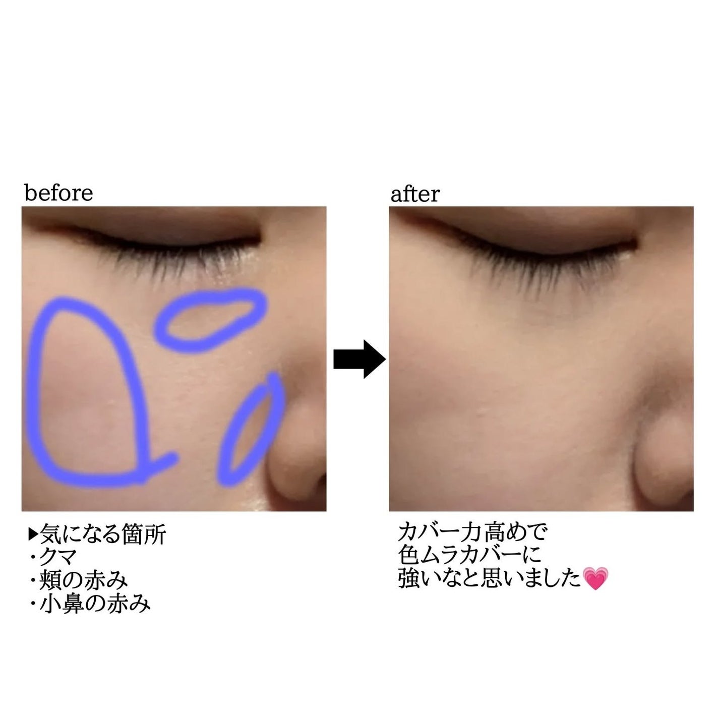 ダーマシンコンシーラー/23years old/リキッドコンシーラーを使ったクチコミ(3枚目)