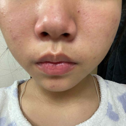 akane_🧸 on LIPS 「みなさんこんにちは!初投稿です.私は今ニキビと脂性肌に悩んでる..」(4枚目)