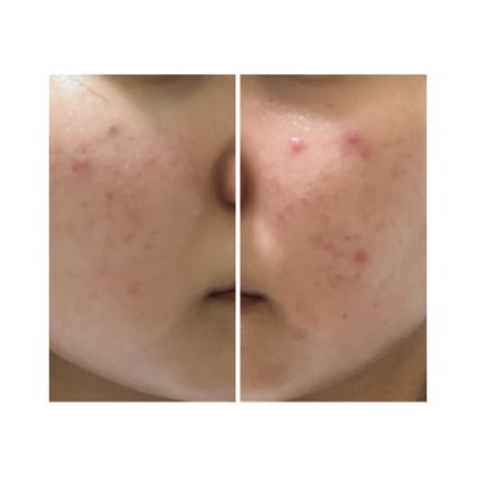 ぽむ on LIPS 「2023.9.13皮膚科に受診 エピデュオとヘパリン処方1枚目..」(4枚目)