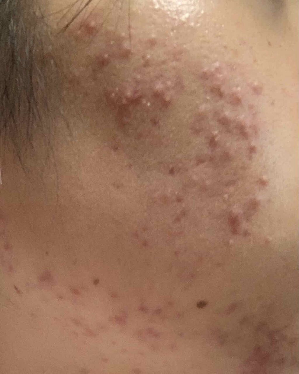 ロゼット洗顔パスタ アクネクリア/ロゼット/洗顔フォームを使ったクチコミ（2枚目）