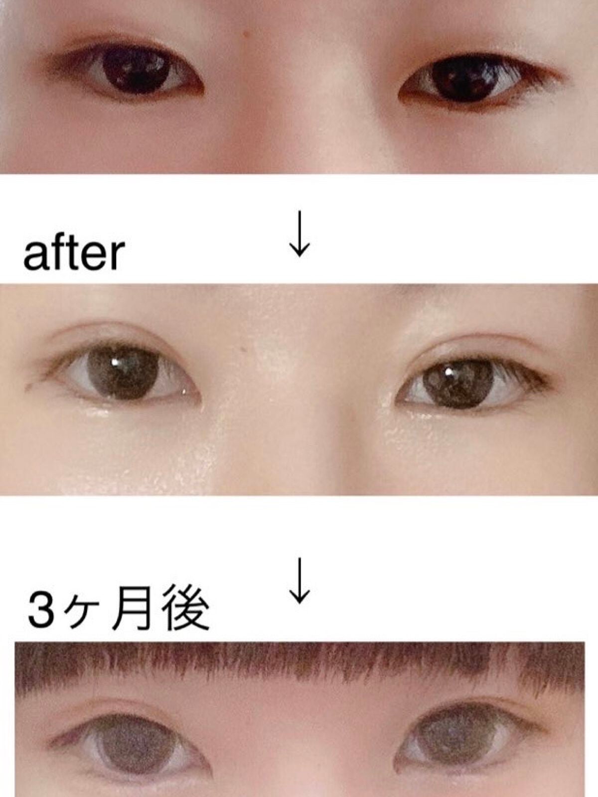 すずな on LIPS 「【二重埋没法】経過観察と私見👀今回はコスメとかではないですが。..」(1枚目)