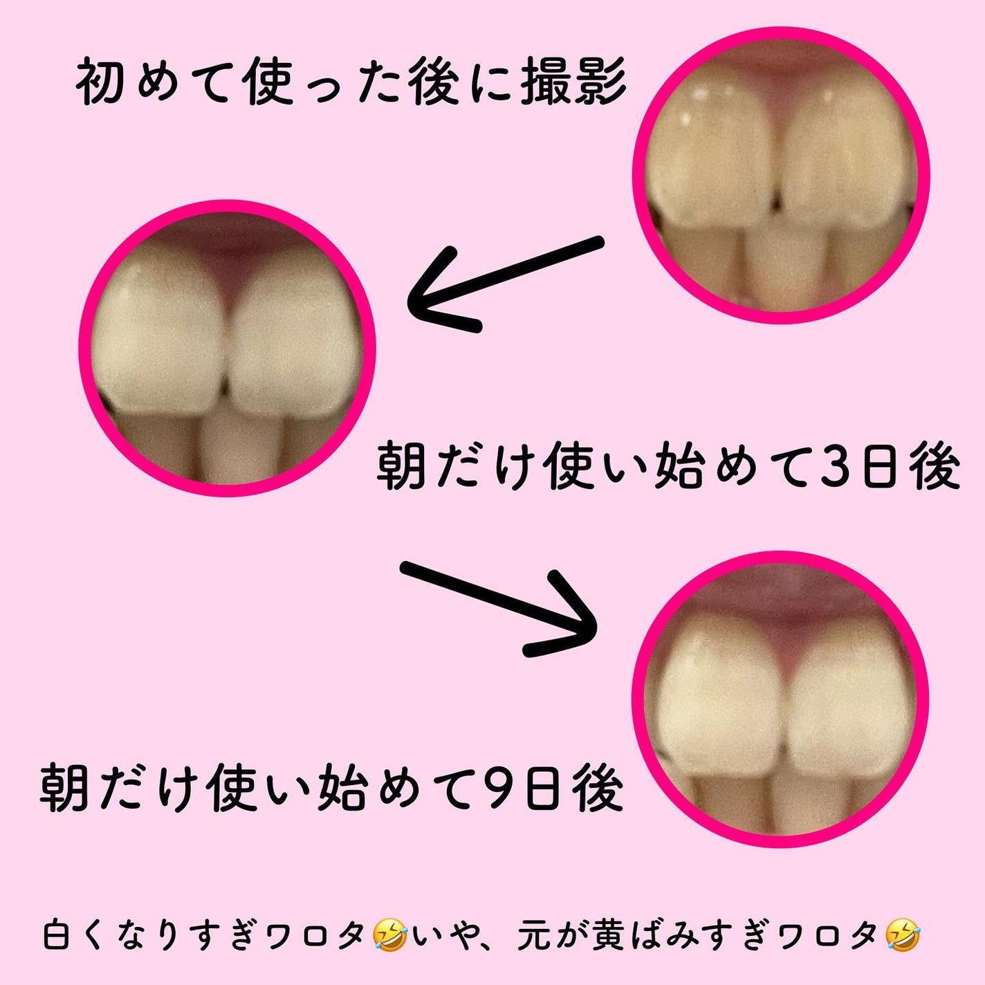 ホワイトニング美白歯磨き粉/EUTHYMOL/歯磨き粉を使ったクチコミ(6枚目)