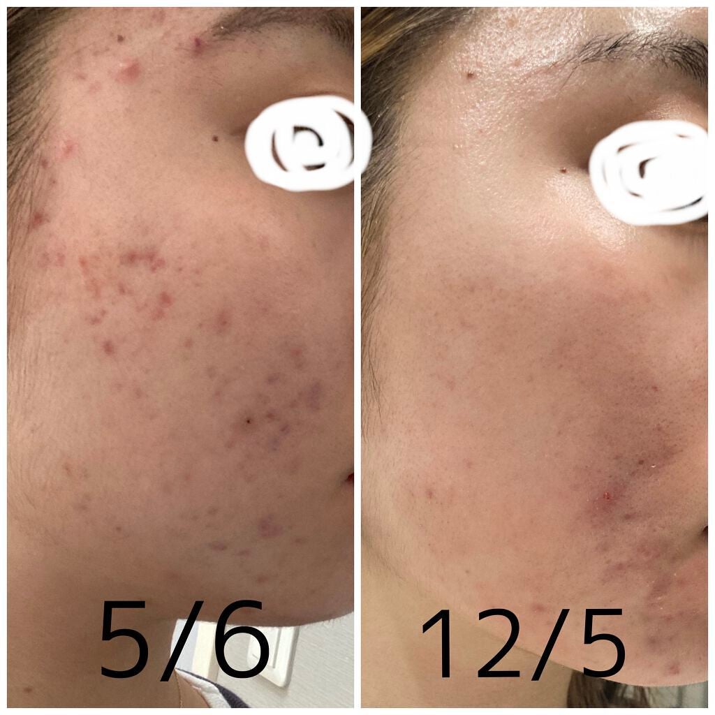 akari on LIPS 「〜ニキビ経過〜本格的にニキビ治療をはじめて7ヶ月が経ちました!..」(1枚目)