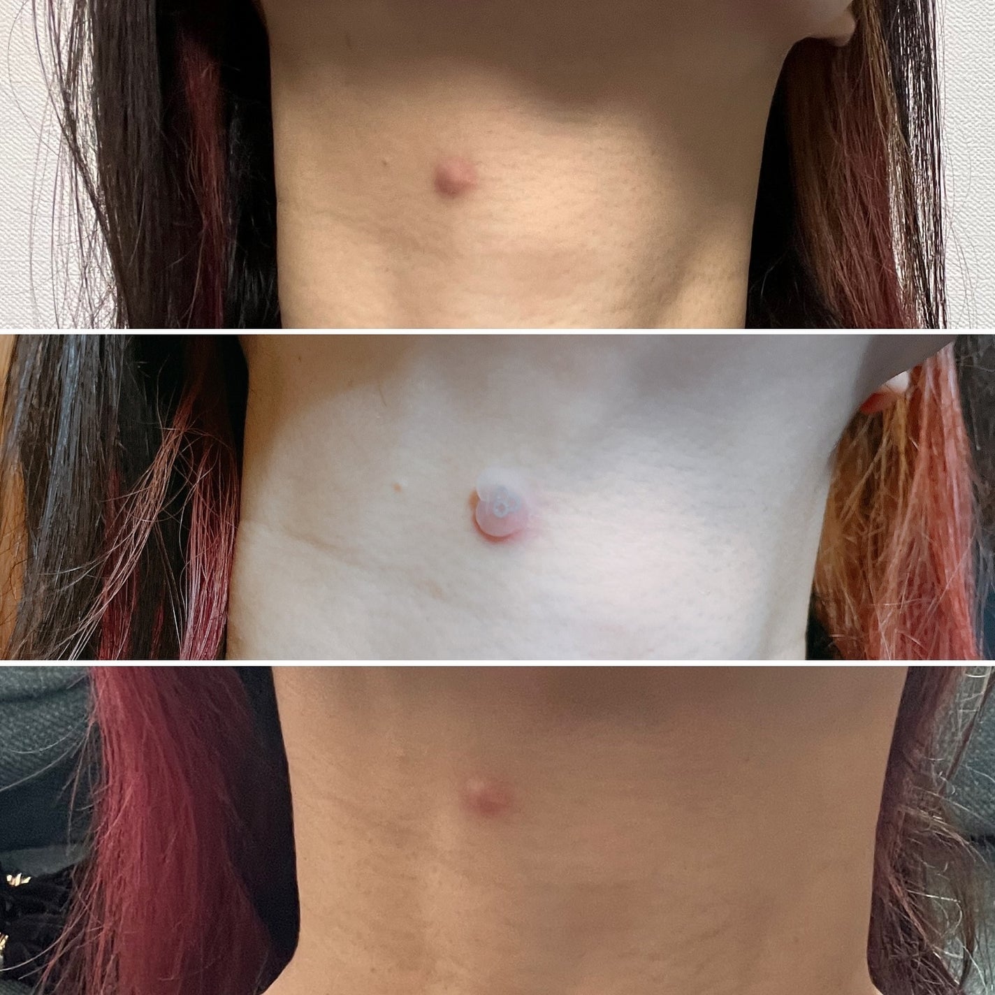 ACマグネシウムパッチ ミニ/スノーツープラス/にきびパッチを使ったクチコミ(4枚目)