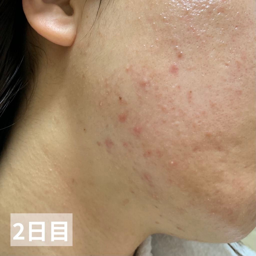 ペアアクネクリームW(医薬品)/ペア/その他を使ったクチコミ(4枚目)