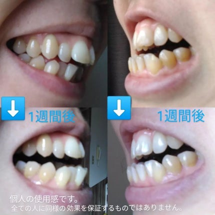 CURAPROX CS 5460/CURAPROX/歯ブラシを使ったクチコミ(2枚目)