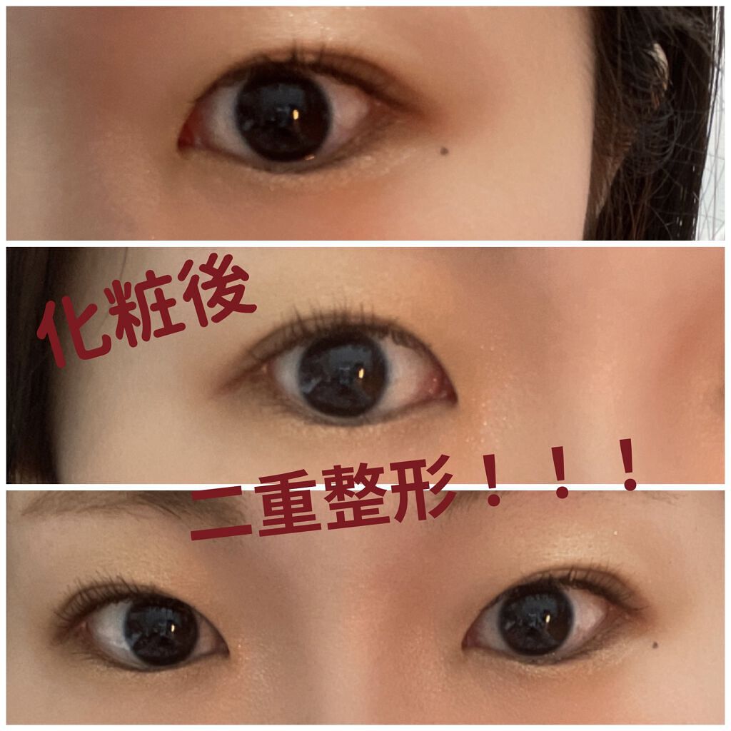 二重整形/その他を使ったクチコミ（1枚目）