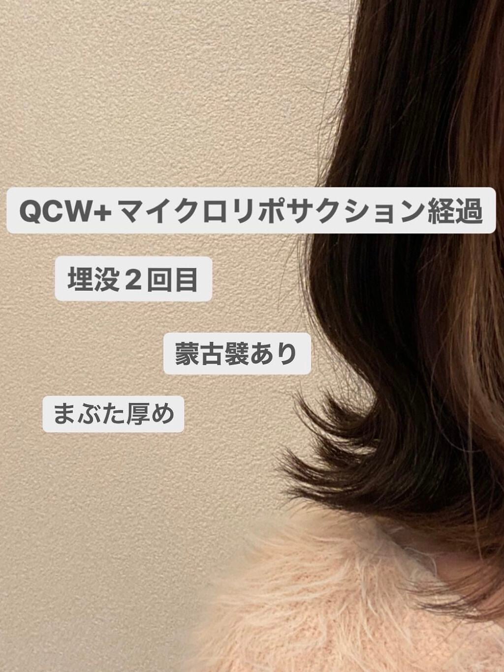 ピーチ on LIPS 「先日2回目の埋没手術を湘南美容外科にてしてきたので経過を載せて..」(1枚目)