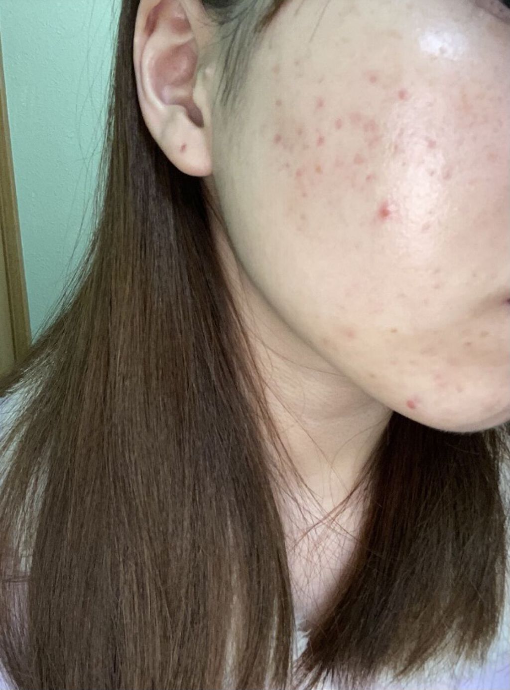 ペアアクネクリームW(医薬品)/ペア/その他を使ったクチコミ（1枚目）