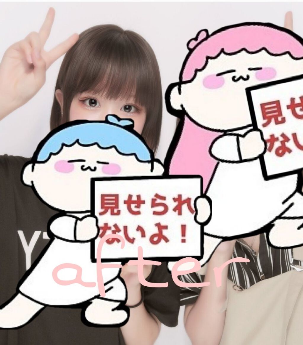 二重整形/その他を使ったクチコミ（2枚目）