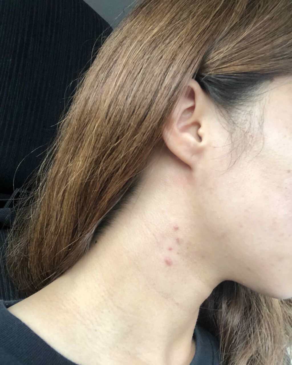 ペアアクネクリームW(医薬品)/ペア/その他を使ったクチコミ（1枚目）