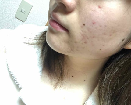 マンスリースキンケアプログラム(旧)/APEX/スキンケアキットを使ったクチコミ(4枚目)