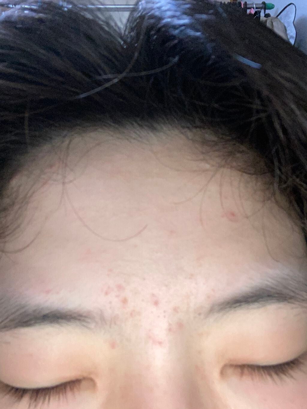 のの on LIPS 「約1ヶ月が経ちました。おでこは良くなってきてますがまだほっぺた..」(4枚目)