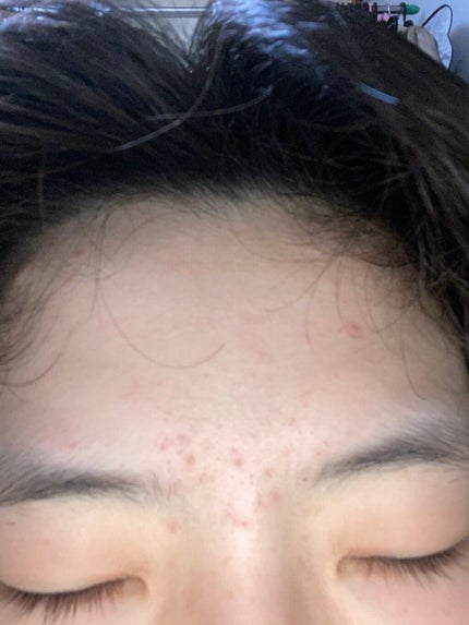 のの on LIPS 「約1ヶ月が経ちました。おでこは良くなってきてますがまだほっぺた..」(4枚目)