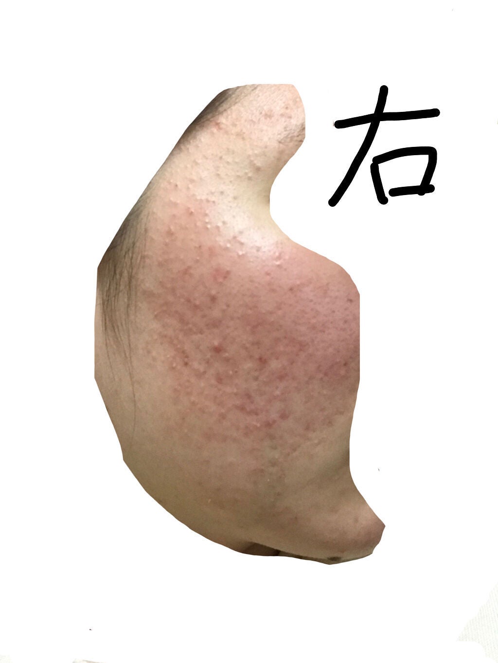 J on LIPS 「#ニキビ_肌断食1ヶ月と22日目です!自分の中での変化はわりと..」(3枚目)