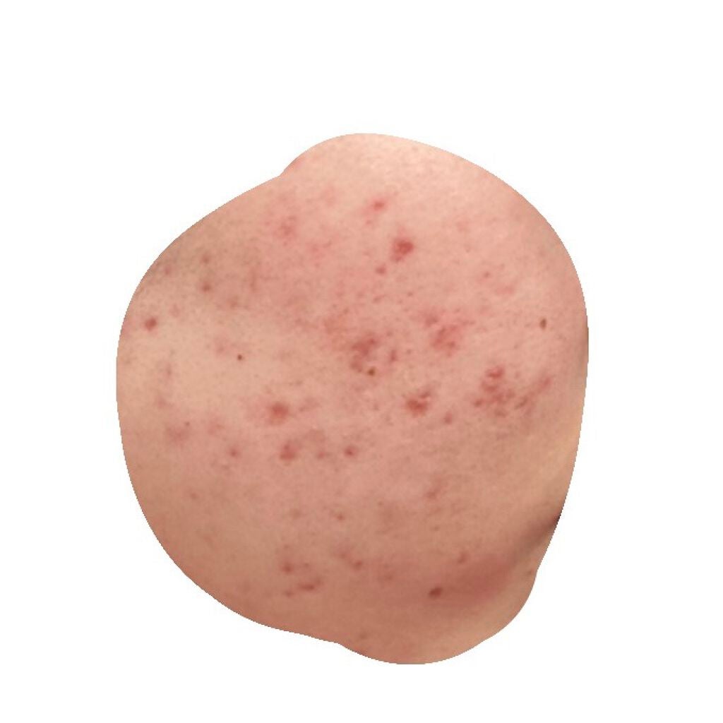 pink_sounds_dlm on LIPS 「赤みがひどい。写真でもわかるくらい毛穴が汚い。毛穴が開いている..」(1枚目)