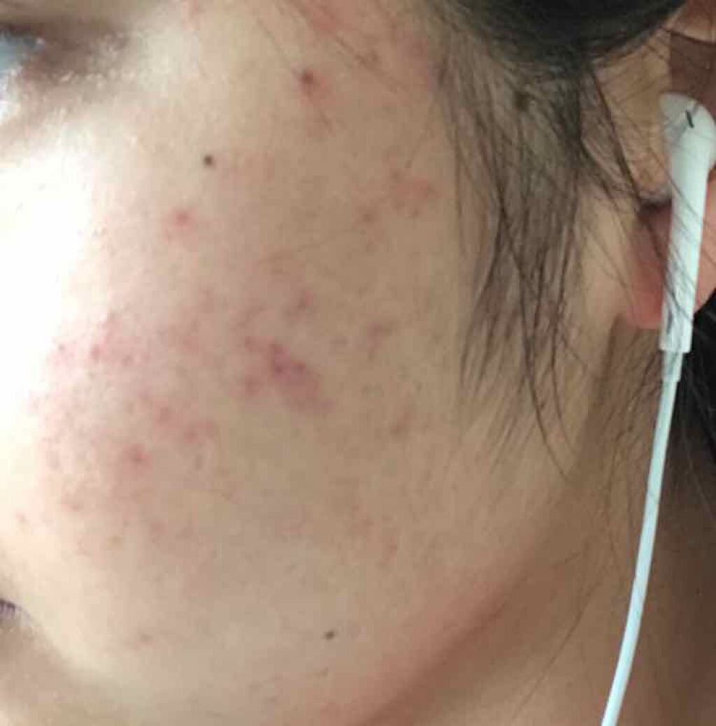 薬用保湿化粧水/オードムーゲ/化粧水を使ったクチコミ（2枚目）