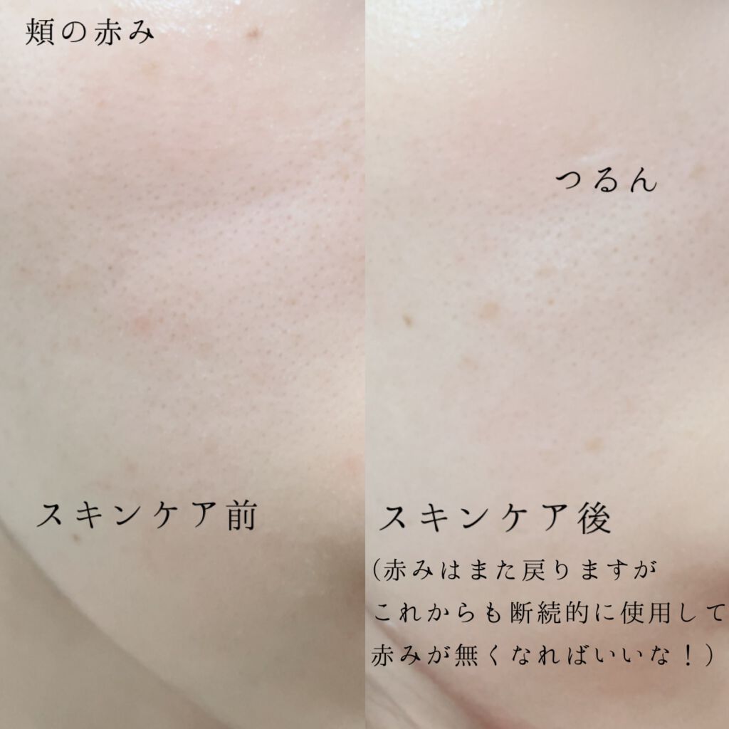 ピンクティーツリートナー/APLIN/化粧水を使ったクチコミ(4枚目)