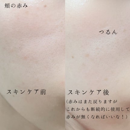 ピンクティーツリートナー/APLIN/化粧水を使ったクチコミ(4枚目)