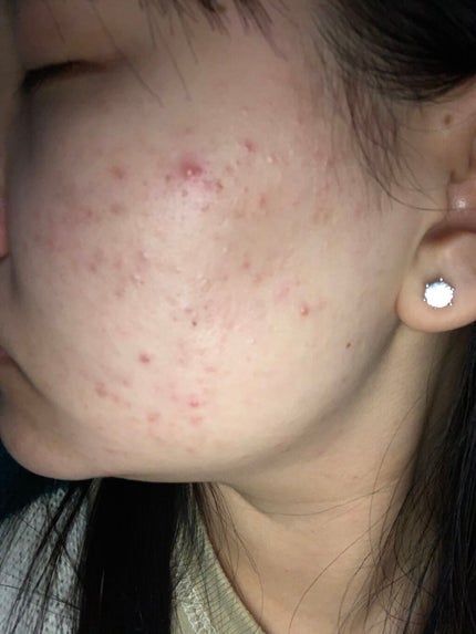 ティーツリーケア ソリューション エッセンシャルマスクEX/MEDIHEAL/シートマスク・パックを使ったクチコミ(3枚目)