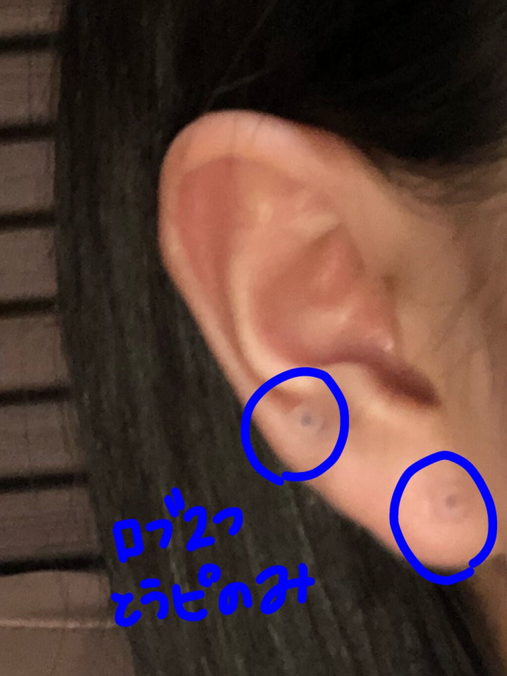 オロナインH軟膏 (医薬品)/オロナイン/その他を使ったクチコミ(2枚目)