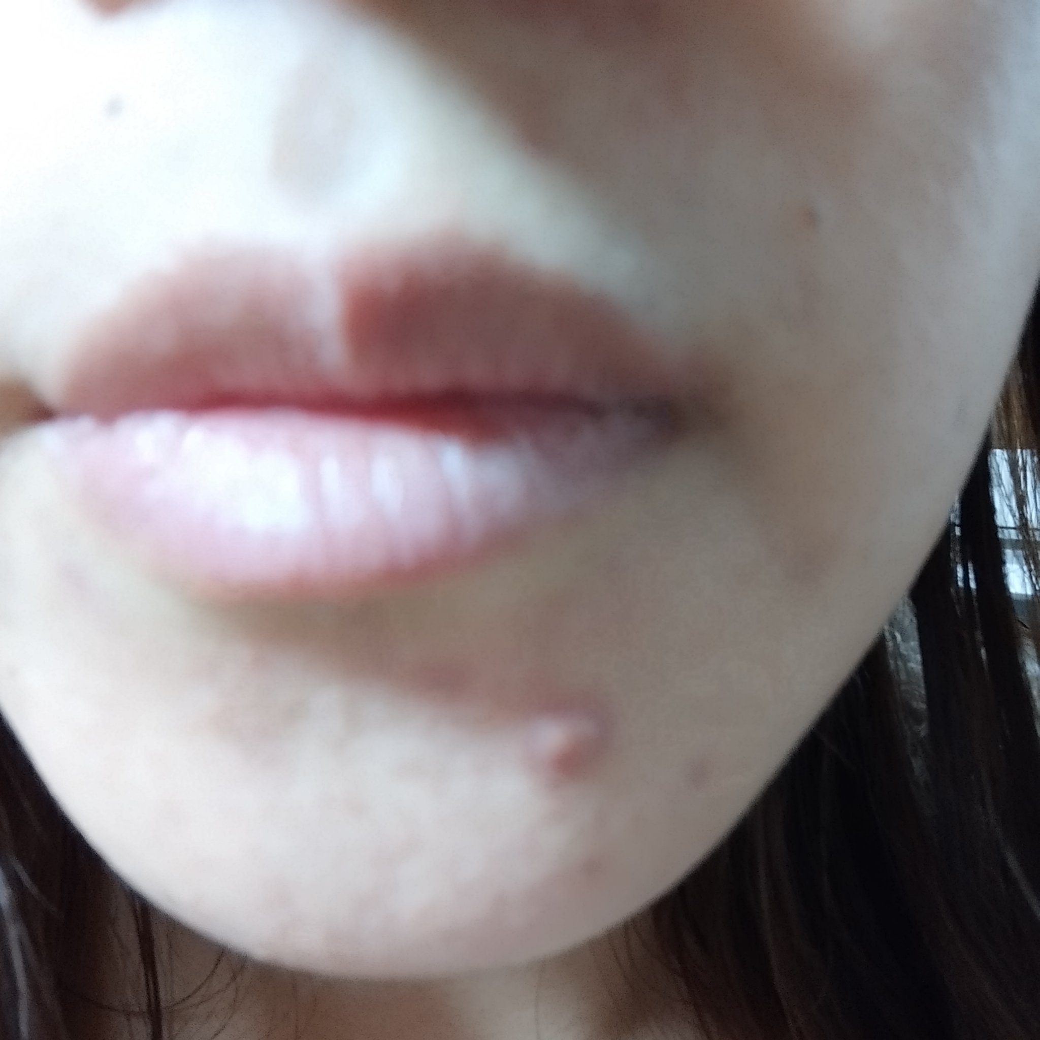 和みるく🍼のクチコミ「【悲報】
明日、従姉妹の結婚式なのに　
昨日！！、顎ニキビができました😭😭😭

なので急いでニ.....」（3枚目）