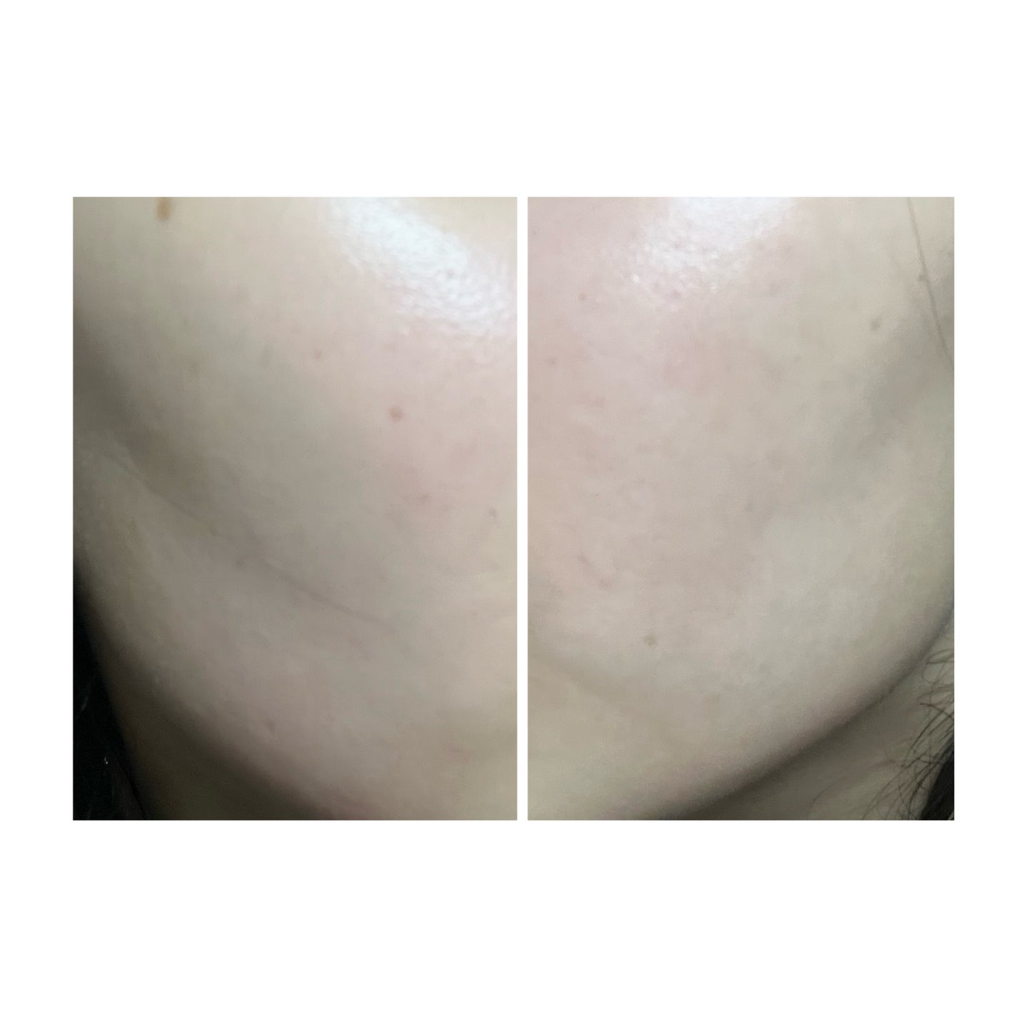 ぽむ on LIPS 「2023.9.13皮膚科に受診 エピデュオとヘパリン処方1枚目..」(2枚目)