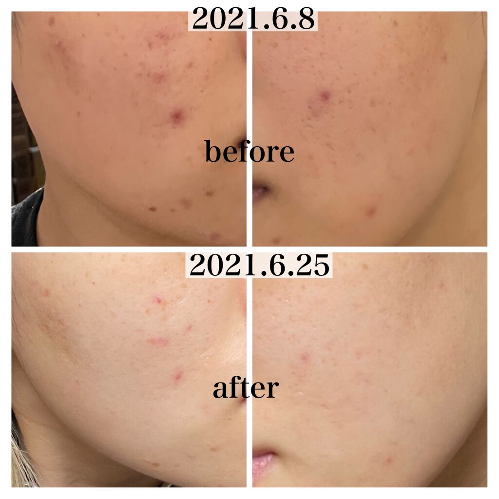 ドクタージャルト シカペアー フェイシャルカーミングミスト/Dr.Jart+/ミスト状化粧水を使ったクチコミ(4枚目)