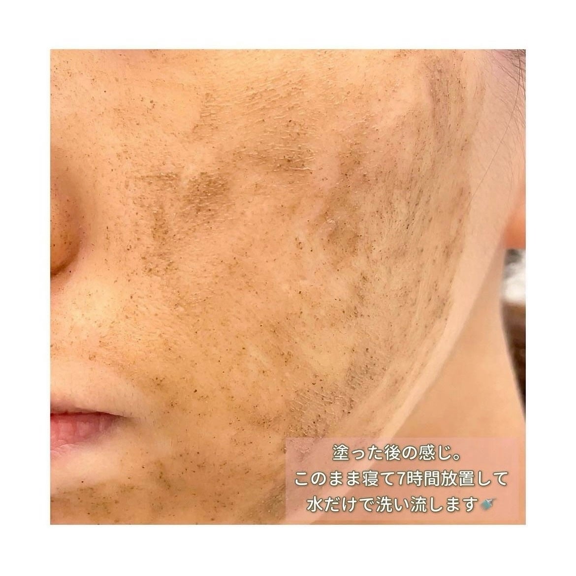 ダーマスキンピーリング/BQCELL/その他キットセットを使ったクチコミ(6枚目)