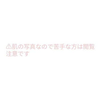 薬用3ステップセット30日サイズ/プロアクティブ/トライアルキットを使ったクチコミ(2枚目)