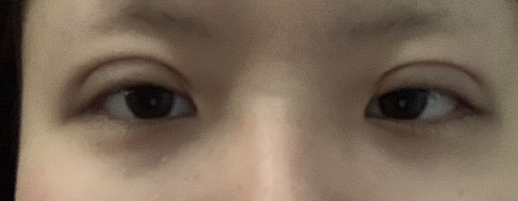 二重整形/その他を使ったクチコミ（3枚目）