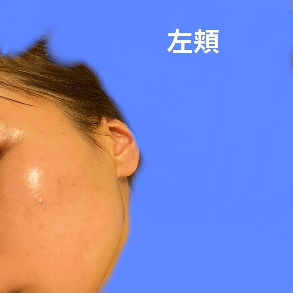 SR on LIPS 「ニキビ記録〜2021/10/15〜スキンケア変わらず。見た目は..」(3枚目)