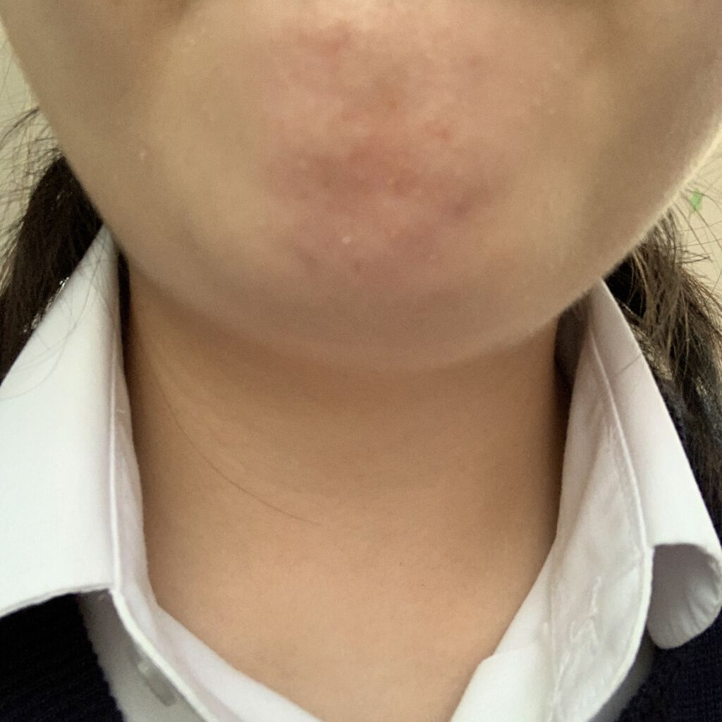 薬用 しみ 集中対策 美容液/メラノCC/美容液を使ったクチコミ（2枚目）