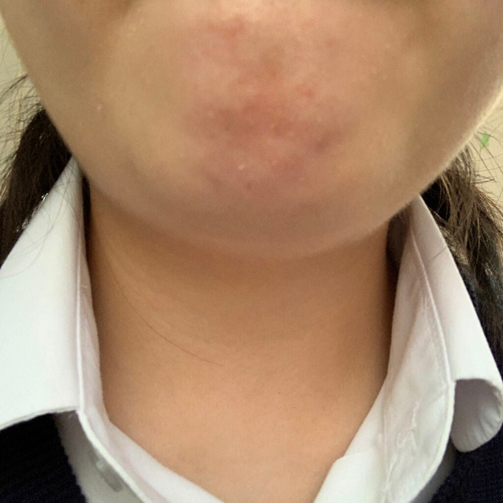 薬用 しみ 集中対策 美容液/メラノCC/美容液を使ったクチコミ(2枚目)