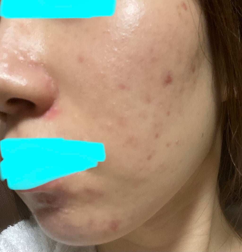 「大人になったらニキビ治るよ」はウソです on LIPS 「自分用の記録です。万年ニキビ面の24歳女がニキビを治すためにが..」(2枚目)