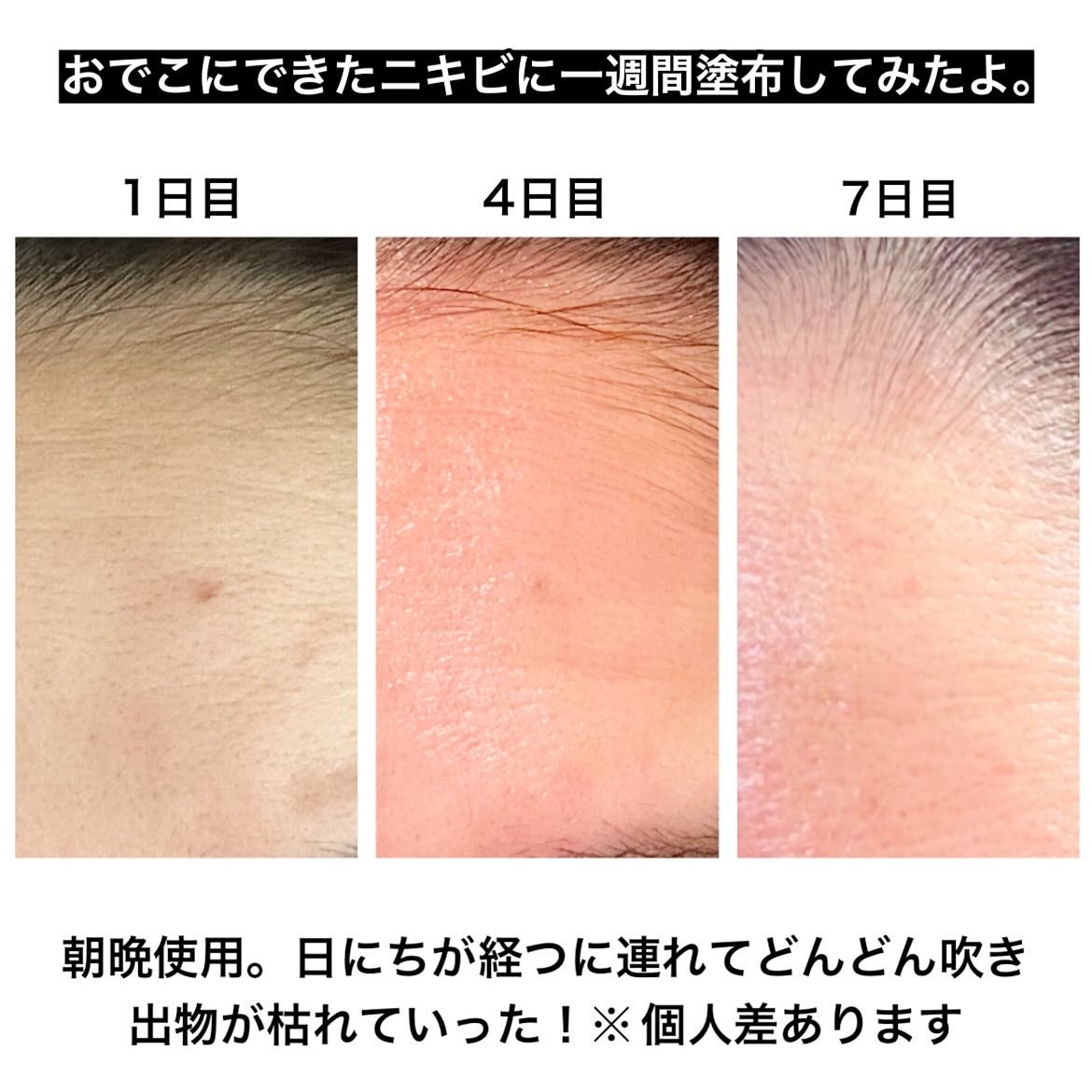 A1カーミング アンプル/VT/美容液を使ったクチコミ(8枚目)