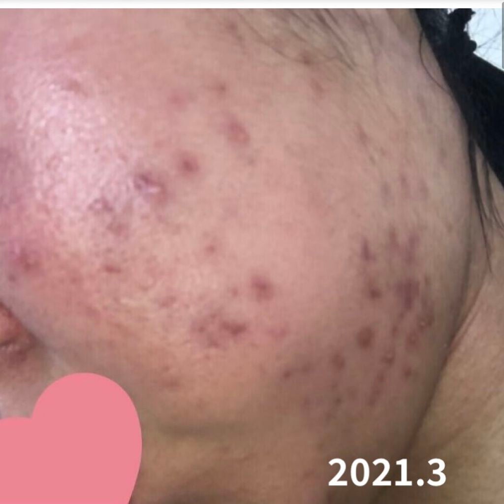 薬用しみ集中対策 プレミアム美容液/メラノCC/美容液を使ったクチコミ(2枚目)