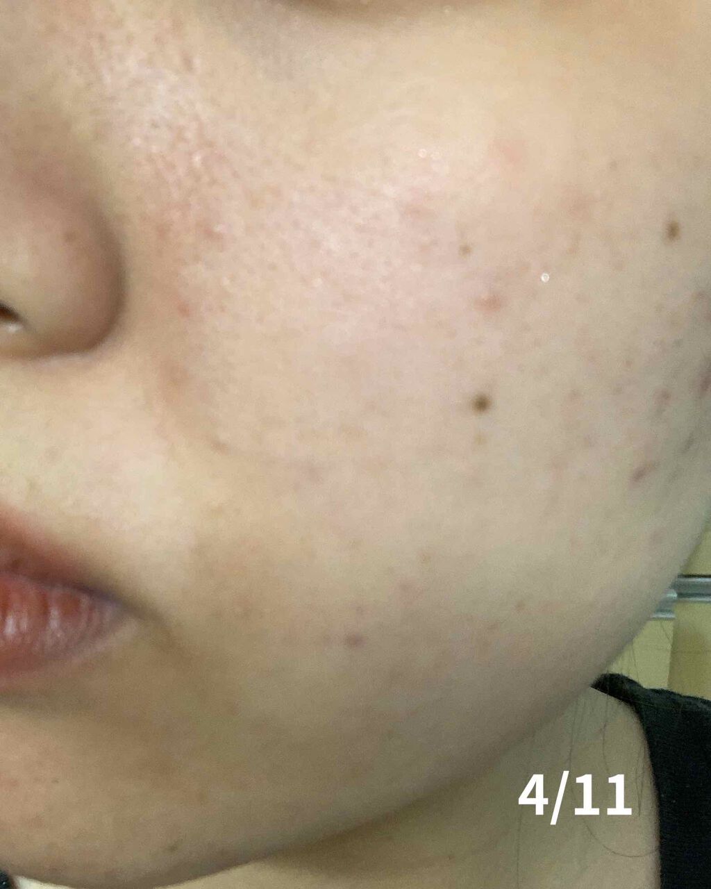 薬用 しみ 集中対策 美容液/メラノCC/美容液を使ったクチコミ（2枚目）