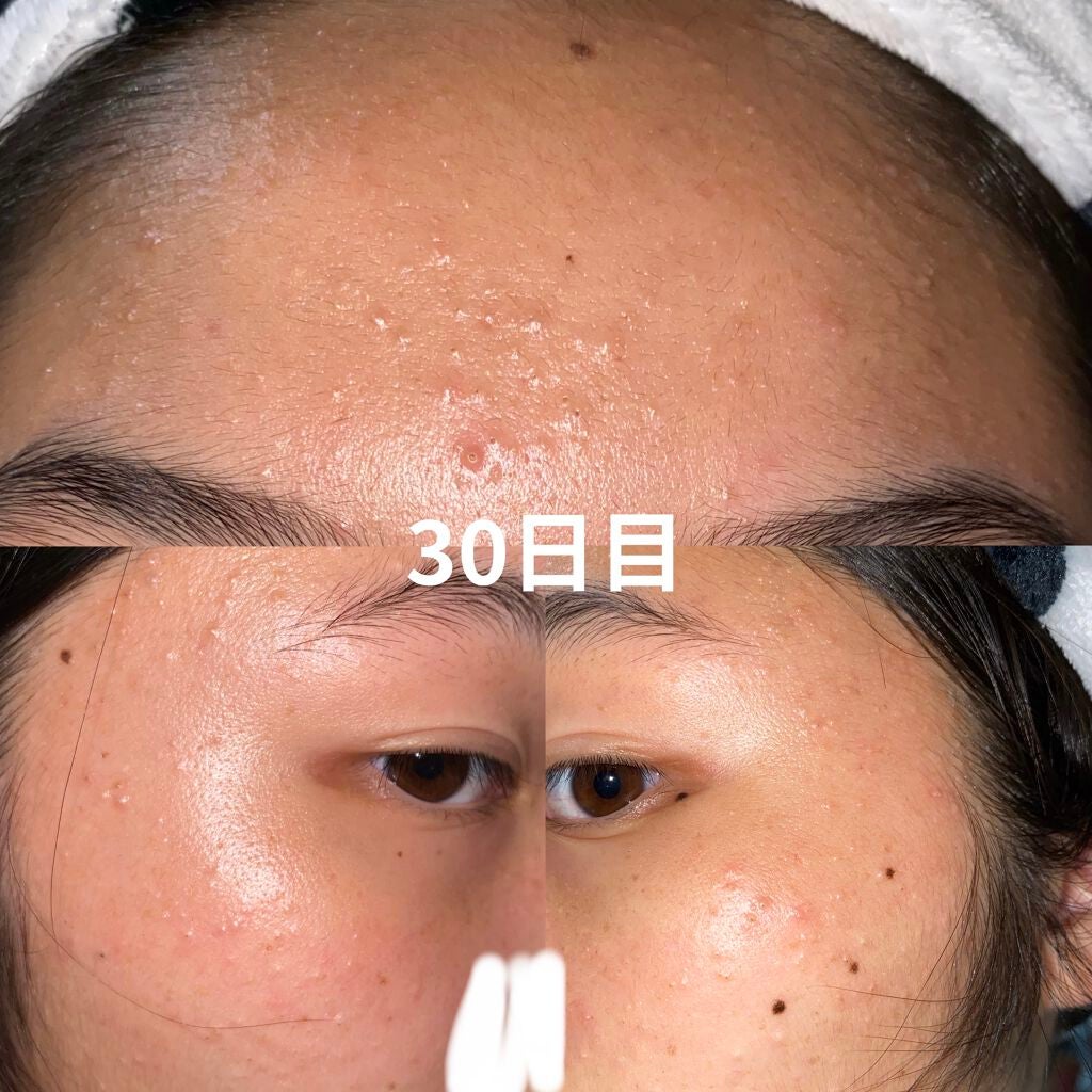 kiho on LIPS 「本気のスキンケアを初めて30日が経ちました!時間って早い、、、..」(1枚目)