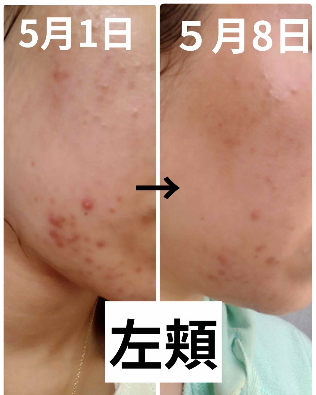 エピデュオゲル/マルホ株式会社/その他を使ったクチコミ（3枚目）