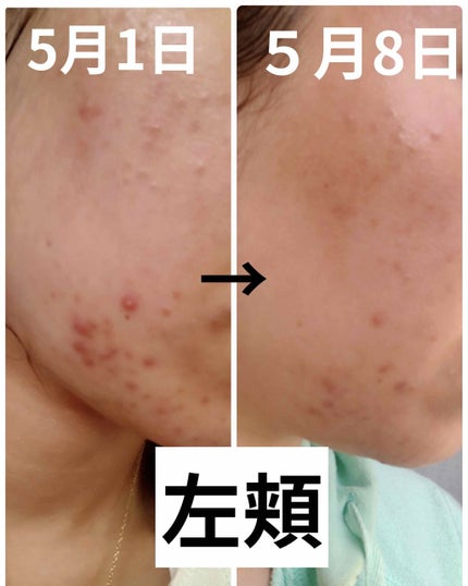 エピデュオゲル/マルホ株式会社/その他を使ったクチコミ(3枚目)