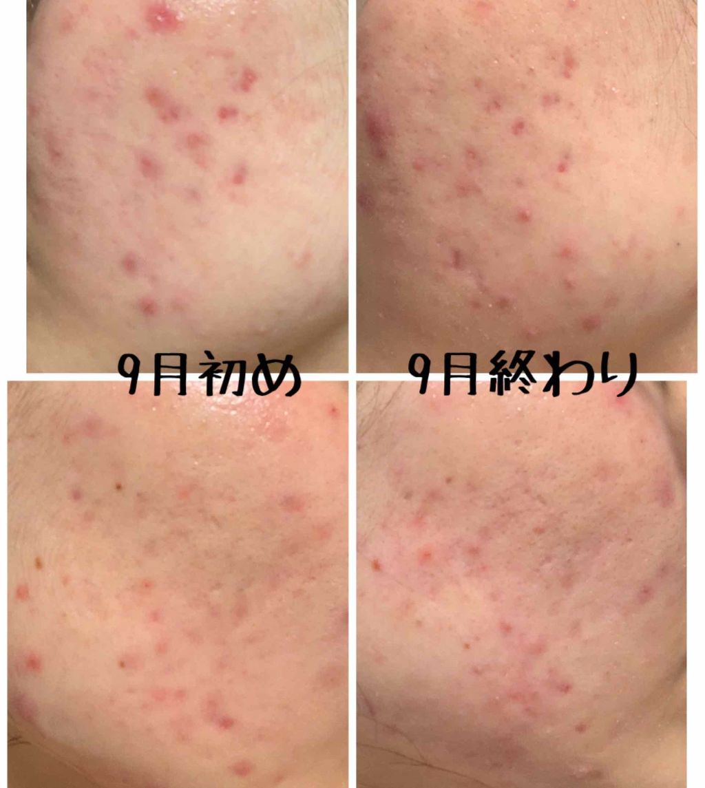 エピデュオゲル/マルホ株式会社/その他を使ったクチコミ（2枚目）