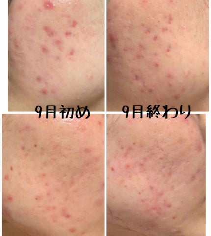 エピデュオゲル/マルホ株式会社/その他を使ったクチコミ(2枚目)