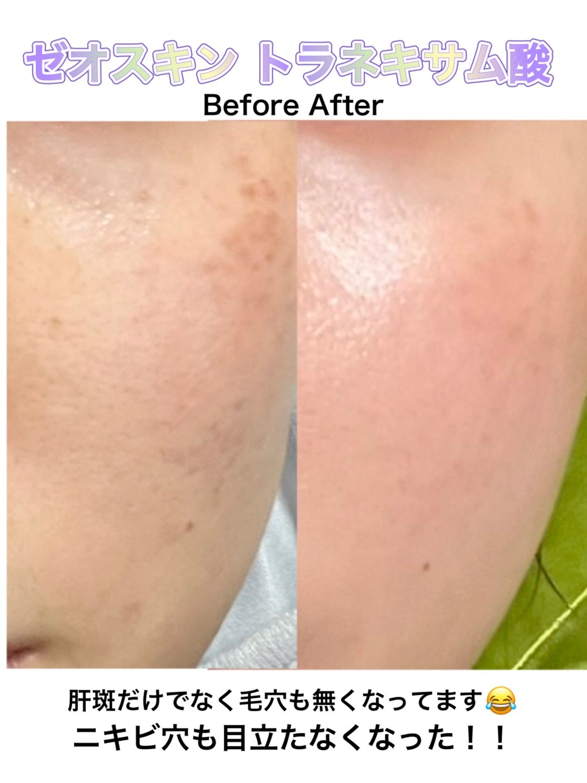 ややフォロバ100 on LIPS 「トラネキサム酸、ゼオスキン3ヶ月レビューしてみました✨トラネキ..」(1枚目)