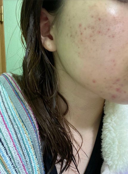 ティーツリーケアソリューション アンプルマスクJEX/MEDIHEAL/シートマスク・パックを使ったクチコミ(1枚目)