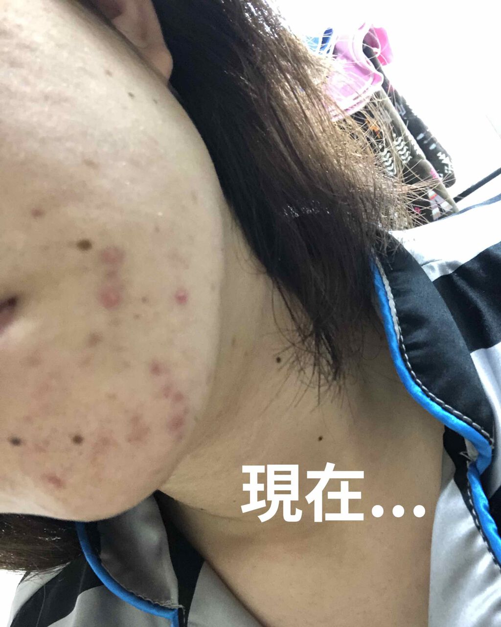 クリンダマイシン酸エステルゲル1%「サワイ」(医薬品)/sawai/その他を使ったクチコミ（2枚目）