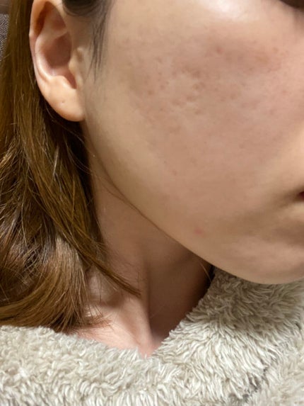 アピットジェル/全薬工業/美容液を使ったクチコミ(2枚目)