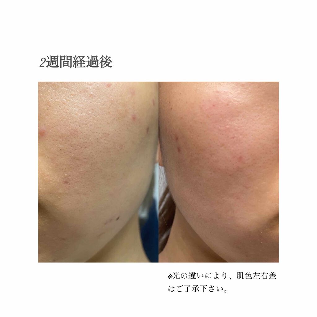 くまちょこ 。 on LIPS 「《 わたしのニキビ、ニキビ跡ケア 》こんにちは。くまちょこです..」(3枚目)